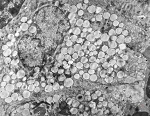 M,54y. | duodenum … Whipple disease, foamy histiocyte M,54y. | duodenum … Whipple disease, foamy histiocyte